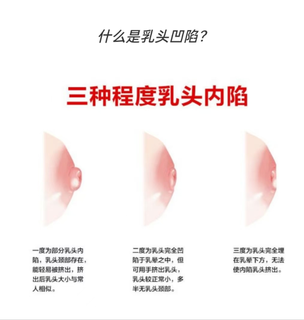 乳頭凹陷媽媽也能成功哺乳：應對策略與孕期準備